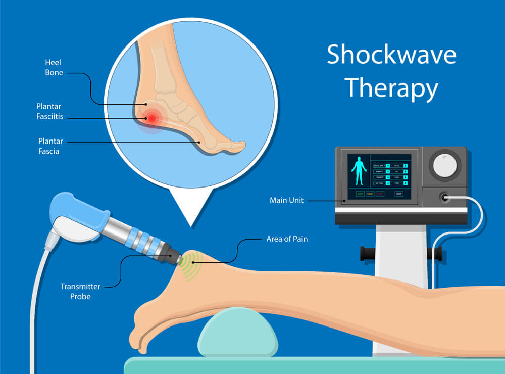 Shockwave therapy in Mississauga